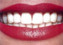 diş beyazlatma 2